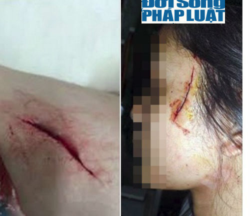 Hoang mang tin đồn cô gái bị rạch mặt ở Hà Nội