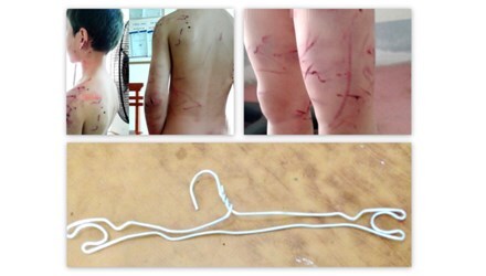 Bé 7 tuổi bị cha đánh dã man vì nghi trộm 10.000 đồng