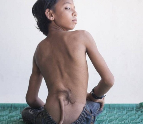 Bé trai Ấn Độ được tôn xưng là Thần Khỉ vì có “đuôi” mọc sau lưng