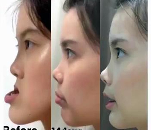 Cô gái có hàm lệch lột xác đến không ngờ sau phẫu thuật