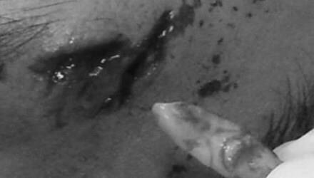 Va chạm mạnh, răng nanh cô gái 