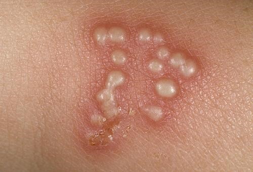 Những dấu hiệu của làn da cảnh báo bệnh tình dục nguy hiểm