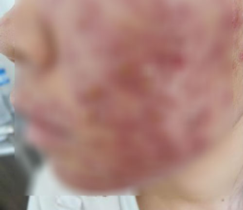 Khốn khổ vì “tiên dược làm đẹp” giá siêu rẻ