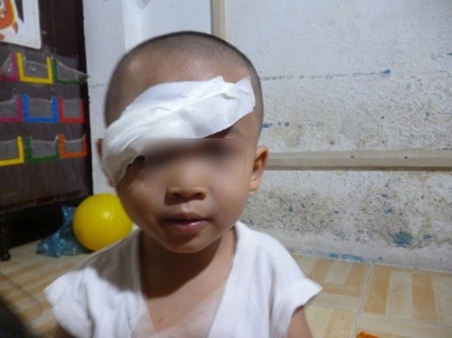 Cháu bé trong vụ ném đá xe khách chỉ còn nhìn được một mắt