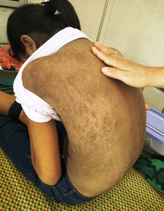 Cuộc sống buồn tủi của nữ sinh mắc bệnh toàn thân đen sạm