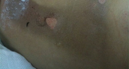 Đang làm đồng, 1 thai phụ tại Hà Nội bị sét đánh nguy kịch