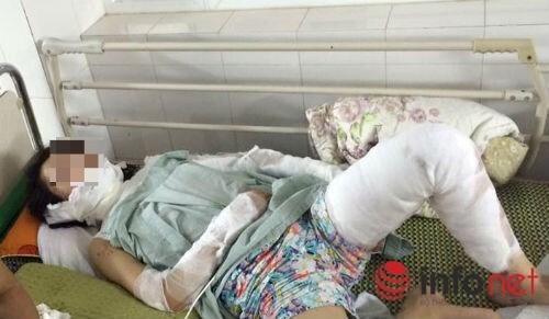 Mặc váy nướng mực cho chồng, vợ trẻ biến thành đuốc sống