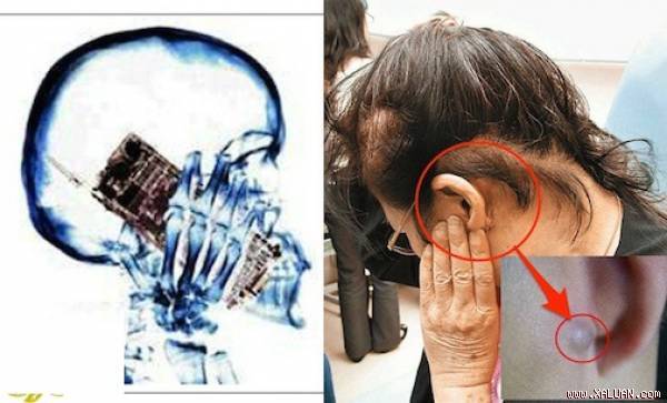 Cô gái mọc u ở tai vì nghe điện thoại quá nhiều