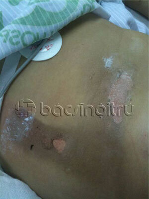 Bị sét đánh, mẹ con thai phụ được cứu sống kỳ diệu