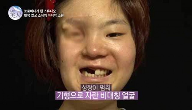 Khó tin ca phẫu thuật thẩm mỹ biến cô gái mất nửa mặt thành mỹ nhân