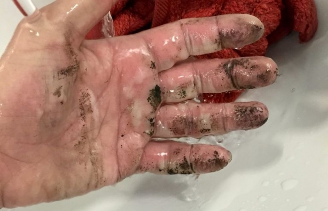 Bị bỏng nặng vì sạc điện thoại phát nổ