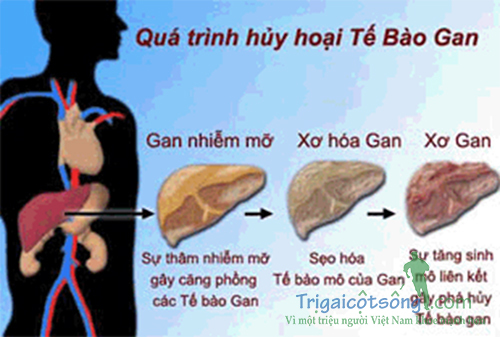 Những dấu hiệu của bệnh gan nhiễm mỡ