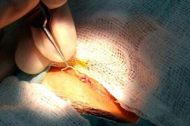 Rùng mình gắp con giun dài 12cm ra khỏi mí mắt người