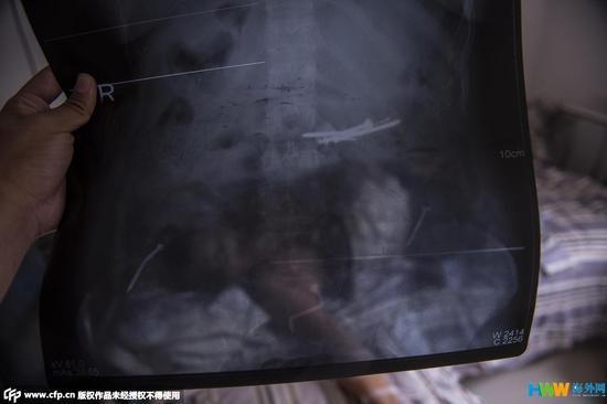 Kì lạ: Người phụ nữ nghiện nuốt đinh và thủy tinh vỡ