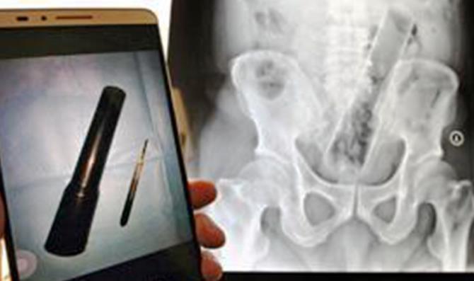 Người đàn ông bị “kẹt” đèn pin trong hậu môn từ chối cho bác sĩ phẫu thuật