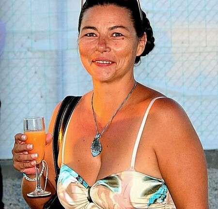 Hi hữu: Người phụ nữ có bào thai chị em song sinh trong bụng hơn 40 năm