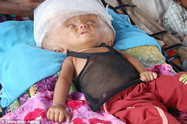 Sự sống mong manh của bé gái bị não úng thủy