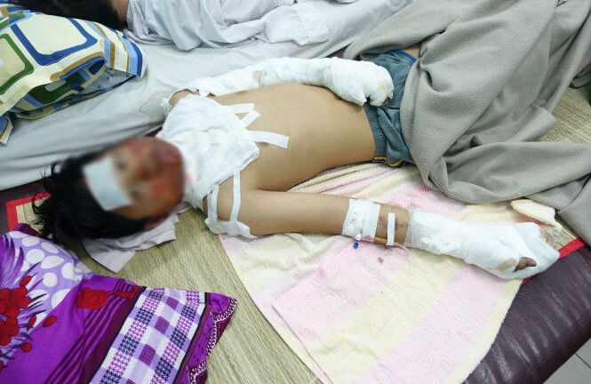 Mê game online, con trai bị mẹ tưới xăng đốt bỏng độ 4