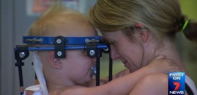 Em bé 16 tháng tuổi được nối lại đầu sau tai nạn kinh hoàng