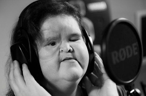 Cảm phục nghị lực sống của cô gái bị biến dạng khuôn mặt