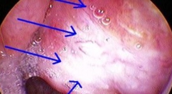 Triệu chứng sớm nhất của bệnh ung thư vòm họng bạn cần nắm rõ