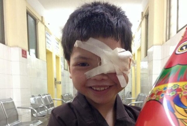 Xót xa cô bé không có bạn vì đôi mắt lồi như quả trứng gà