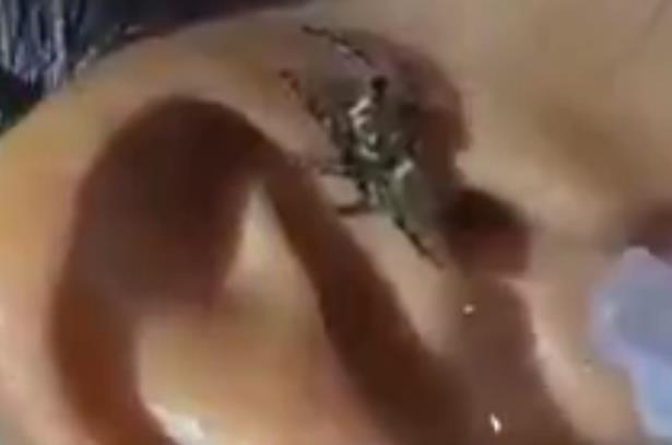 Kinh hoàng xem bác sĩ dụ con nhện từ tai bệnh nhân