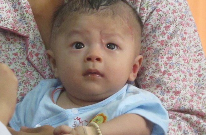 Hình ảnh đáng yêu của bé trai bị đâm xuyên sọ ngày tái khám