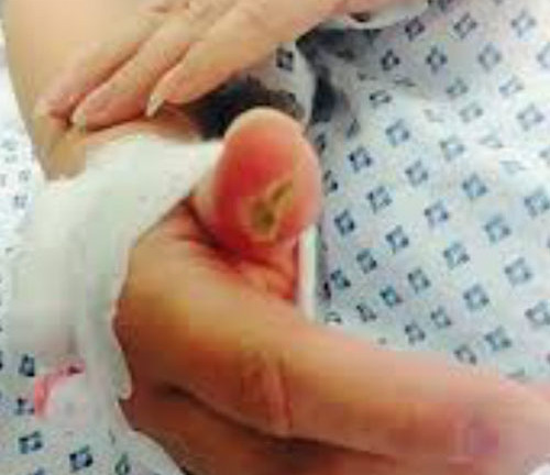 Bị hoại tử ngón tay chỉ vì coi thường điện giật 