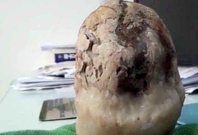 Phát hiện sỏi thận nặng gần 2kg trong cơ thể cụ ông 70 tuổi