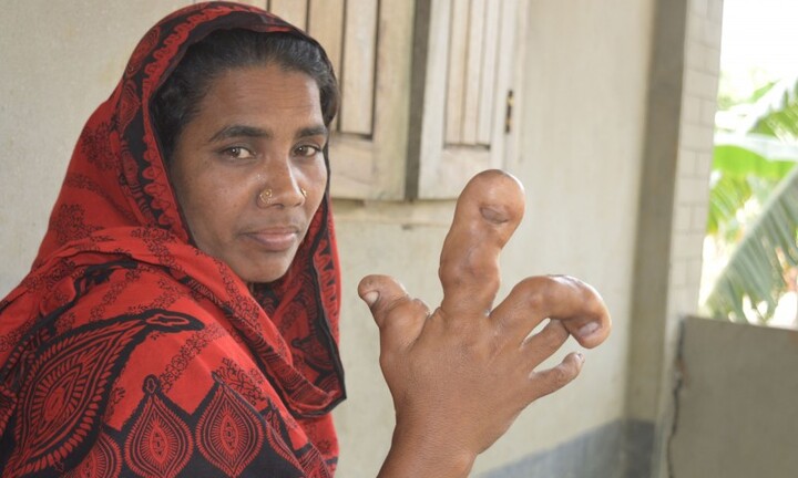 Người phụ nữ có bàn tay phải to lạ thường