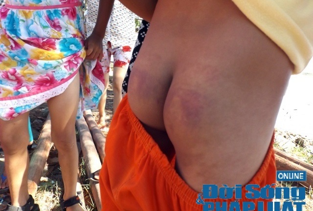 Hơn 10 học sinh lớp 2 bị giáo viên dùng thước đánh vì… viết chậm