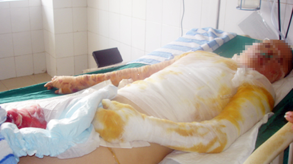 Vụ đổ xăng thiêu sống người yêu: Cô gái cháy không còn mảnh vải che thân