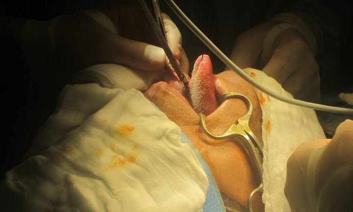 Tái tạo lưỡi từ da tay để chữa ung thư