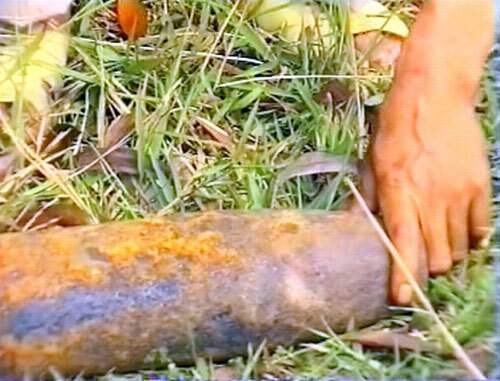 Đứt lìa cánh tay do cưa quả đạn pháo