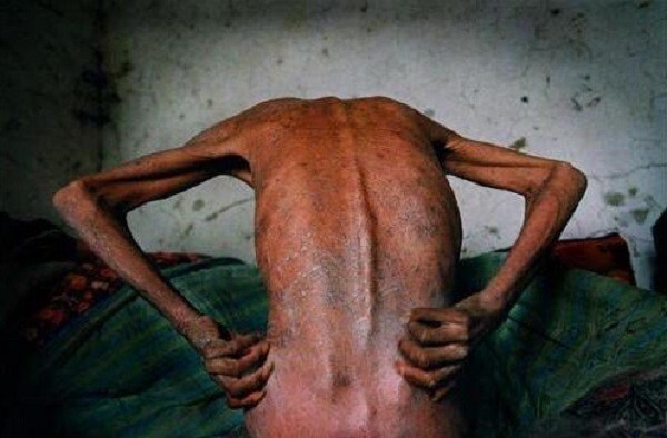 Xót xa hình ảnh cơ thể người khi chuyển sang giai đoạn AIDS