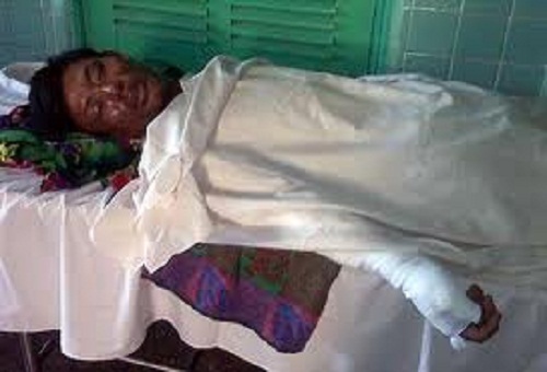 Đắk Lắk: Một phụ nữ mang thai 7 tháng nguy kịch do bỏng xăng 