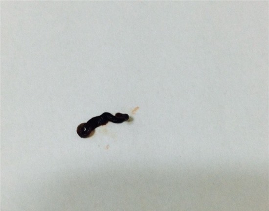 Con vắt dài 3cm sống trong mắt bệnh nhân