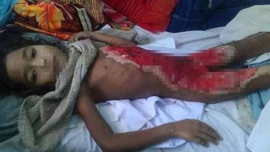 Nướng ngô, bé 6 tuổi bị bỏng 90\% cơ thể