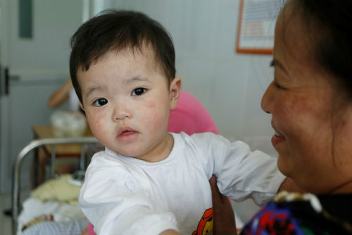 Dịch sởi nặng nhất trong hàng thập kỷ ở Việt Nam