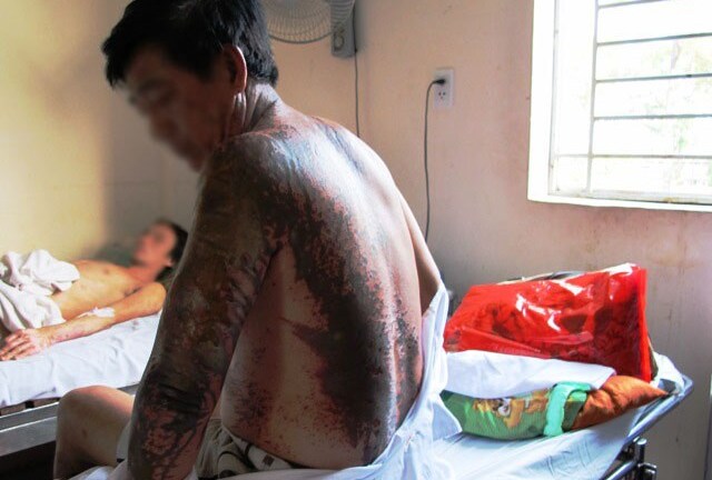 Bình Dương: 4 người bị tạt axit khi đang đi tập thể dục