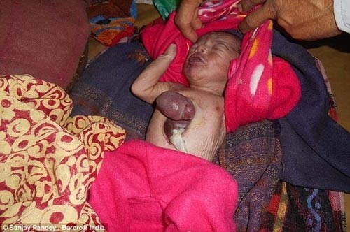 Xót lòng những bé sơ sinh có nội tạng ngoài cơ thể