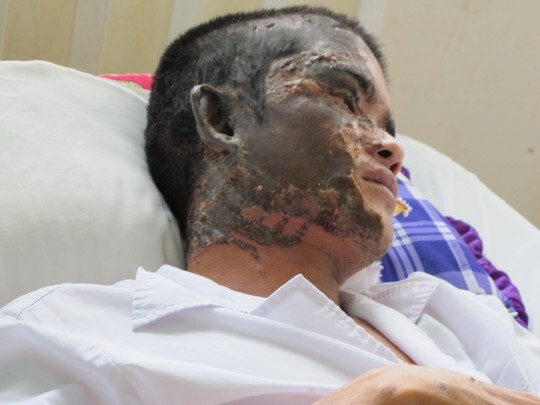 Bỗng dưng bị tạt axít lúc...đang ngủ