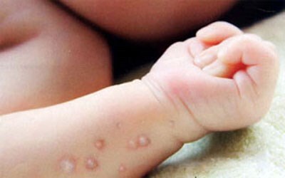 Vắc xin thủy đậu đã sẵn sàng ở cả hai miền Bắc, Nam
