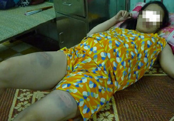 Đánh vợ nhập viện vì đi khám thai không xin phép