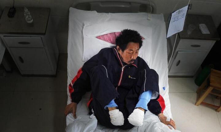 Tự cắt cụt ngón chân vì không có tiền phẫu thuật