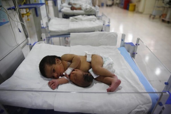 Xót thương bé sơ sinh có đầu mọc ở bụng