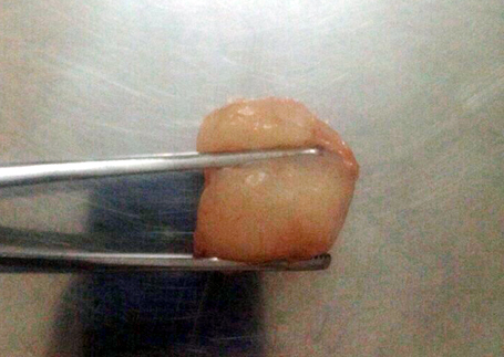 Hà Nội: Hóc vải, bé trai 6 tuổi tử vong thương tâm