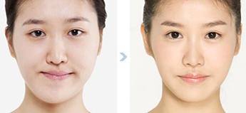 Gọt cằm công nghệ Hàn Quốc
