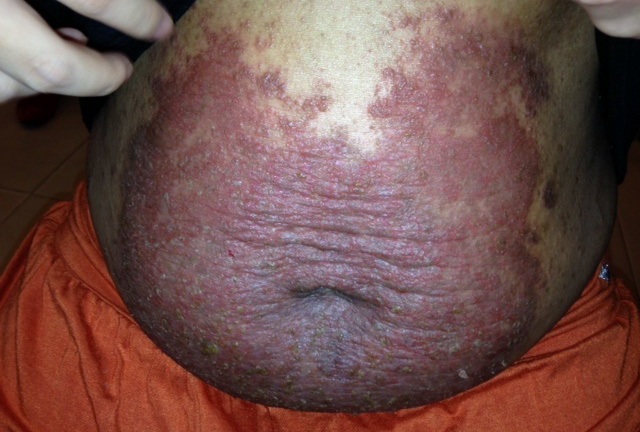 Hỏi đáp trị bệnh vẩy nến ở Bảo Thanh Đường